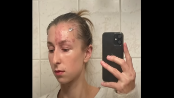 Primeiro varicela, depois herpes zoster