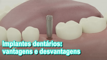 Implantes dentários: vantagens e desvantagens