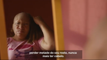 Mulheres ribeirinhas seguem vítimas de escalpelamento em barcos a motor na Amazônia