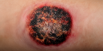 "Combate ao Melanoma: Estratégias Vitais para Prevenção, Diagnóstico e Tratamento"