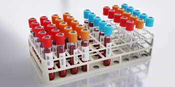 Novo Exame de Sangue Detecta Doença de Parkinson Anos Antes dos Sintomas