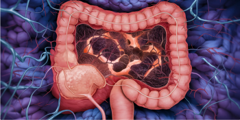 Novo Estudo Alerta: Dieta Rica em Carne Vermelha Pode Aumentar Risco de Câncer Colorretal
