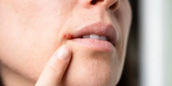 Herpes: Entenda o Vírus e Como Prevenir Suas Recorrências