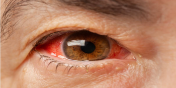 Sintomas de olhos vermelhos e como aliviá-los rapidamente