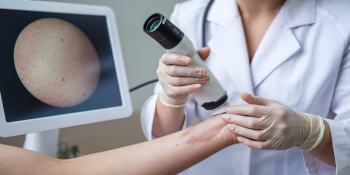 Melanoma: Fatos Essenciais e Diagnóstico Precoce