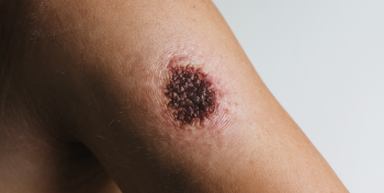Autoexame de Pele: Aprenda o ABCDE do Melanoma e Proteja Sua Saúde
