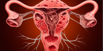 Adenomiose: Como Reconhecer os Sintomas e Buscar Tratamento