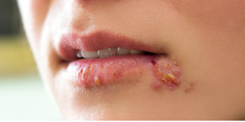 Herpes Genital: O que você precisa saber e como proteger sua saúde