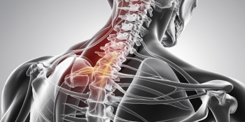 Radiculopatia Cervical e Torácica: Causas, Sintomas e Tratamentos