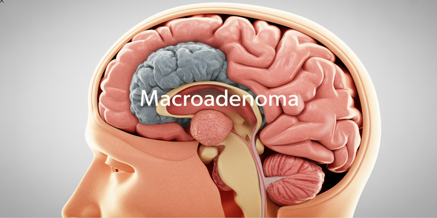 Ilustração de adenoma hipofisário, um tumor geralmente benigno que pode alterar a produção hormonal. / Ilustração Cortesia Editorial Ideia
