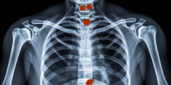 Plasmocitoma Solitário: Quando um Tumor Isolado Pode Confundir com Câncer Sistêmico
