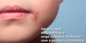 HERPES LABIAL: O QUE OS JORNAIS NÃO CONTARAM SOBRE ESSA CONDIÇÃO SEM CURA