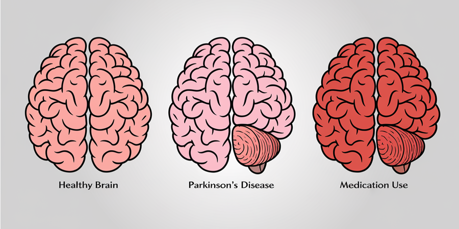 A inteligência artificial permitiu identificar padrões invisíveis da esclerose múltipla, abrindo caminho para tratamentos mais eficazes.