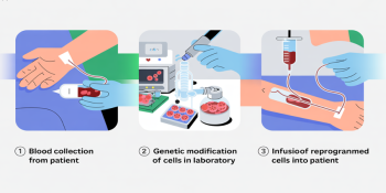 Do Transplante às Células Modificadas: A Evolução no Tratamento do Mieloma Múltiplo