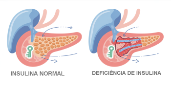 “Diabetes LADA, Tipo 1 e Tipo 2: diferenças que todo adulto precisa entender”