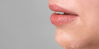 Herpes: 10 mitos e verdades que vão mudar o que você sabe sobre essa infecção